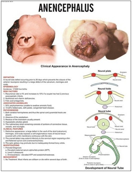 Anencephalus Chart