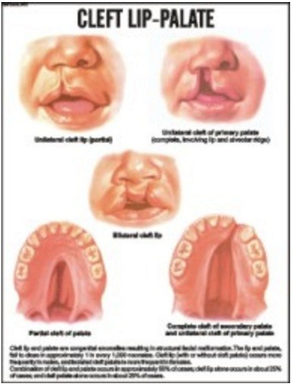 Cleft lip-Palate Chart
