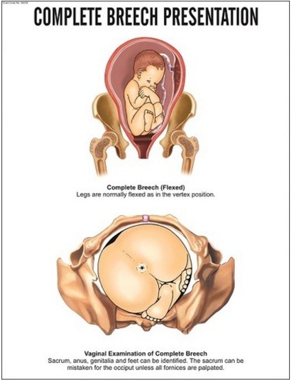 Complete Breech Presentation Chart