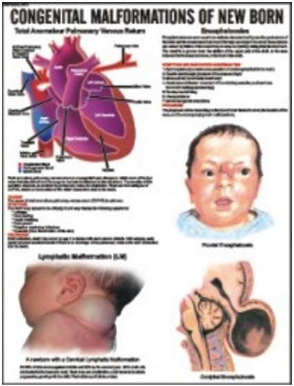 Congenital Malformation of New Born Chart