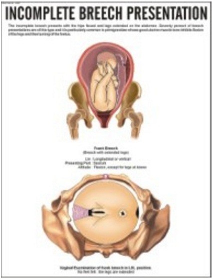 Incomplete Breech Presentation Chart