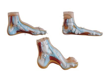 Normal, Flat and Arched Foot Model