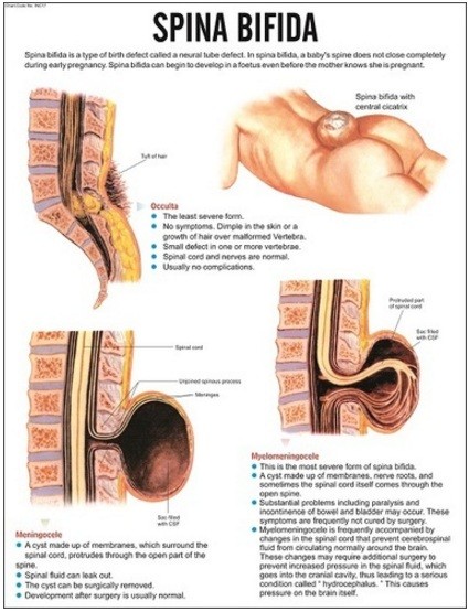 Spina Bifida Chart