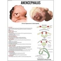 Anencephalus Chart