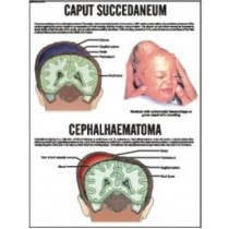 Caput Succedaneum, Cephalhaematoma Chart
