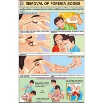 Removal of Foreign bodies Chart