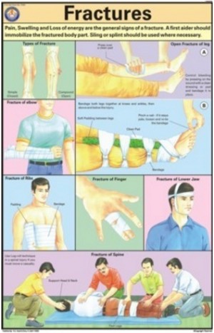 Fractures Chart