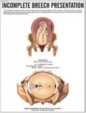 Incomplete Breech Presentation Chart