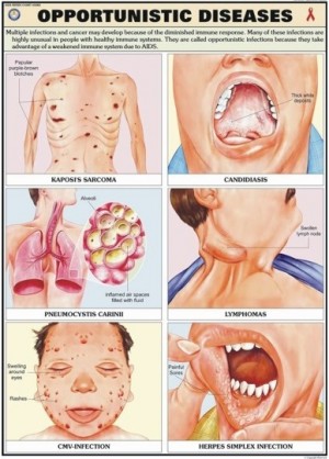 Opportunistic Diseases