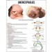 Anencephalus Chart