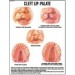 Cleft lip-Palate Chart